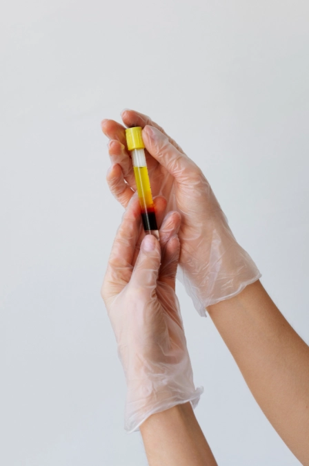 фото плазмы после цетрифугирования для prp терапии